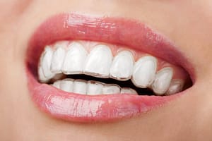 5 Things That Young Adults Must Consider When Choosing An Invisalign Dentist