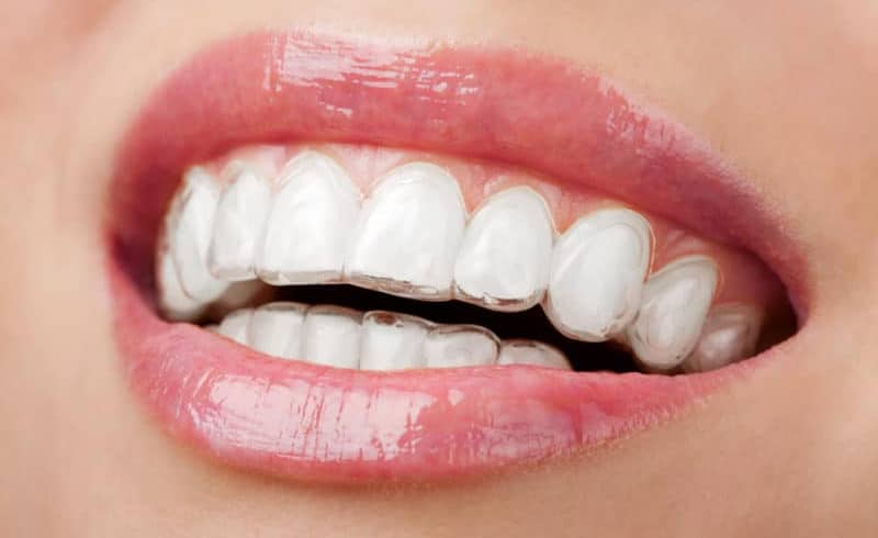 5 Things That Young Adults Must Consider When Choosing An Invisalign Dentist